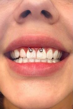Smiley piercing with barbell under upper lip