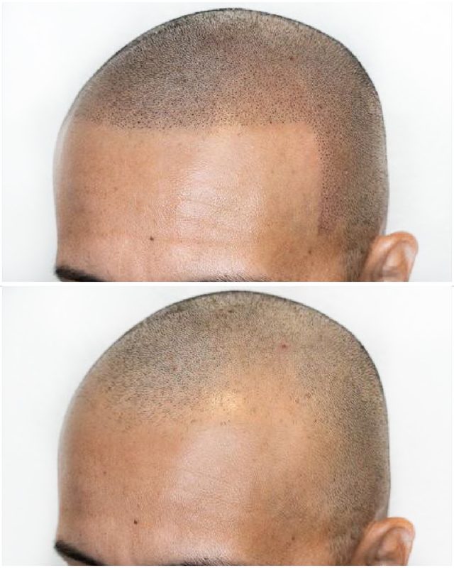 Scalp Pigmentation Result
