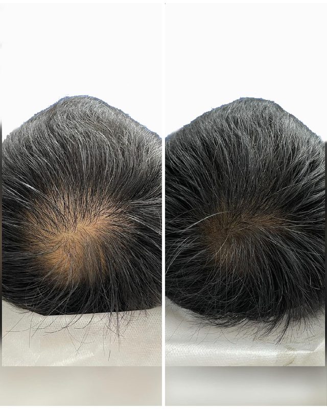 Scalp Pigmentation Result