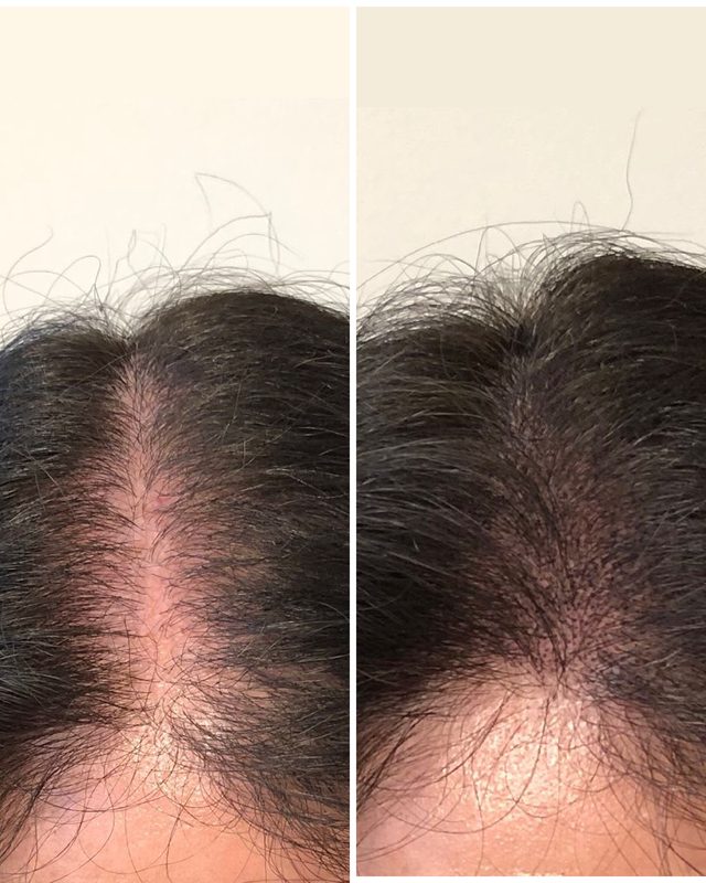 Scalp Pigmentation Result