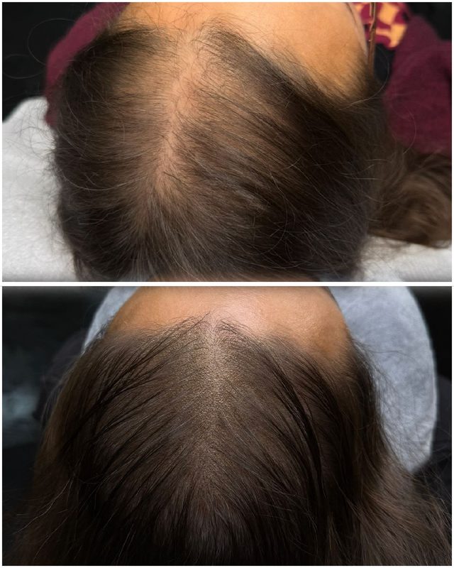 Scalp Pigmentation Result