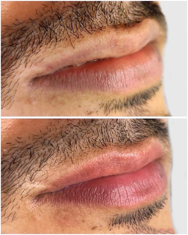 Lip Pigmentation Result