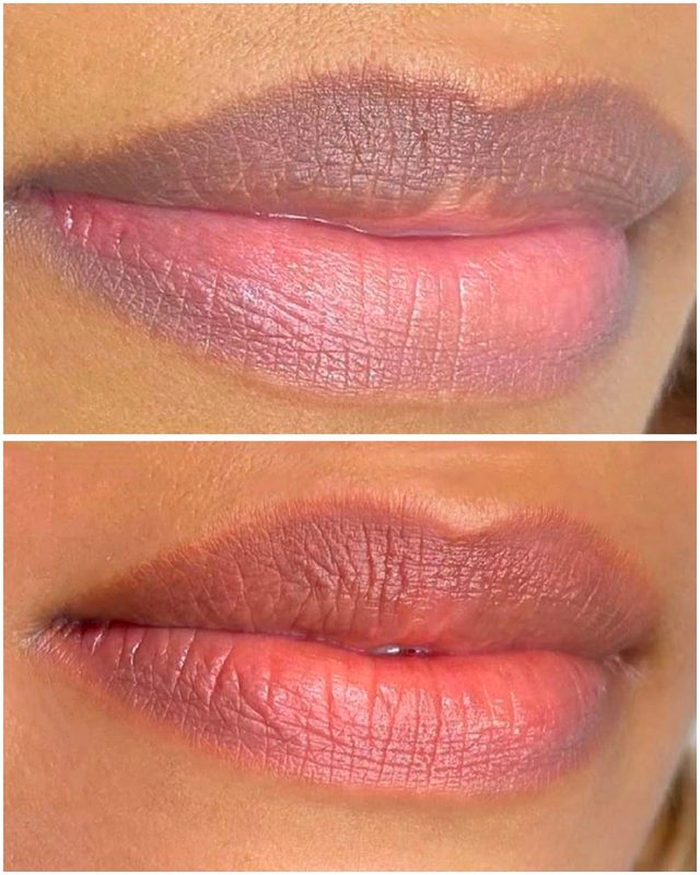 Lip Pigmentation Result