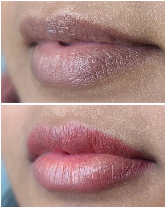 Lip Pigmentation Result