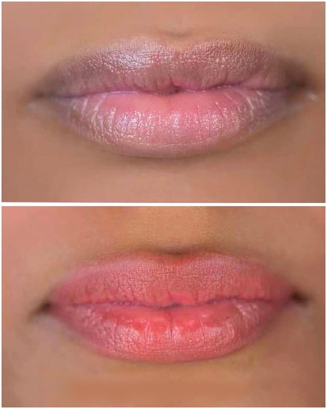 Lip Pigmentation Result